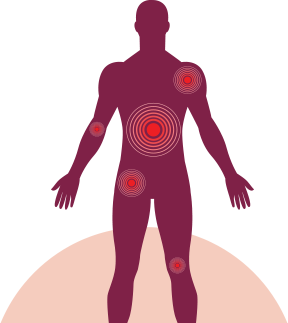 Areas of the body that can be affected by multiple myeloma